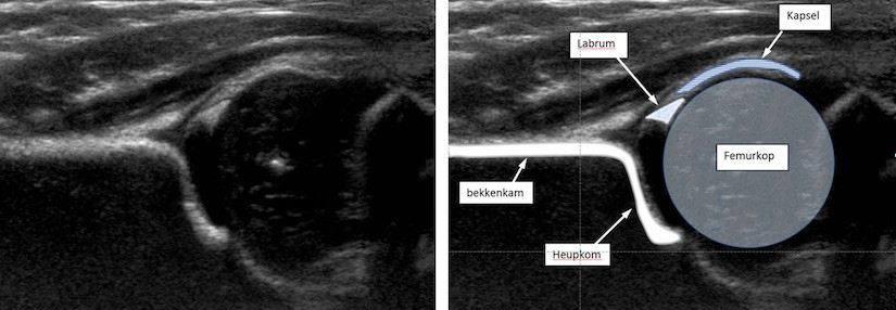 echo heup bij een kind van 3 maanden oud