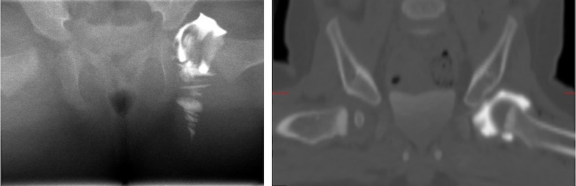 Röntgenfoto en CT-scan met contrastvloeistof rond heupkop